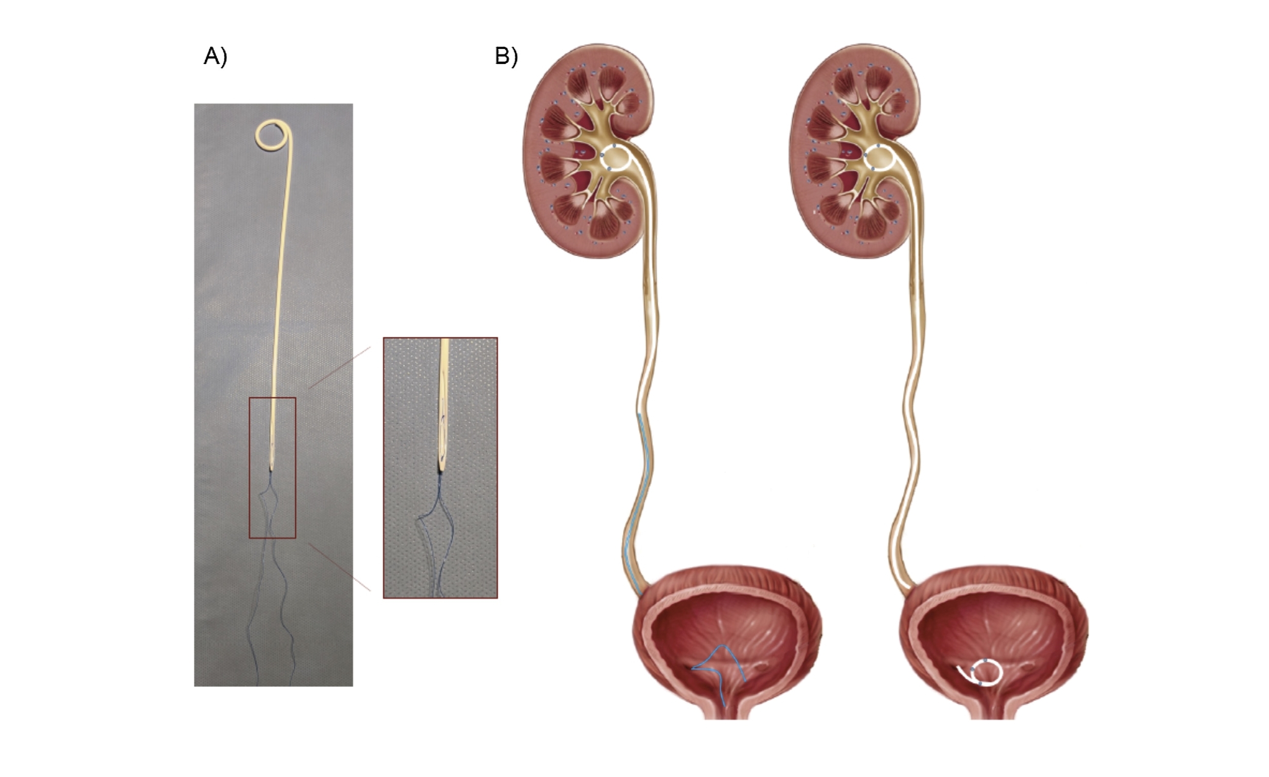 Studie Pigtail Suture stenty