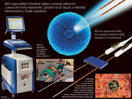 NanoKnife jako zabiják rakovinových buňek