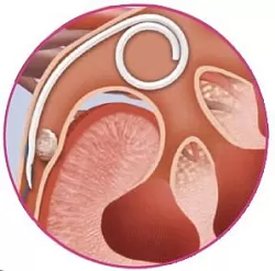 JFil® Ureterální stent