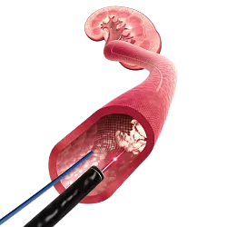 X-Filter™ Anti-migrační filtr